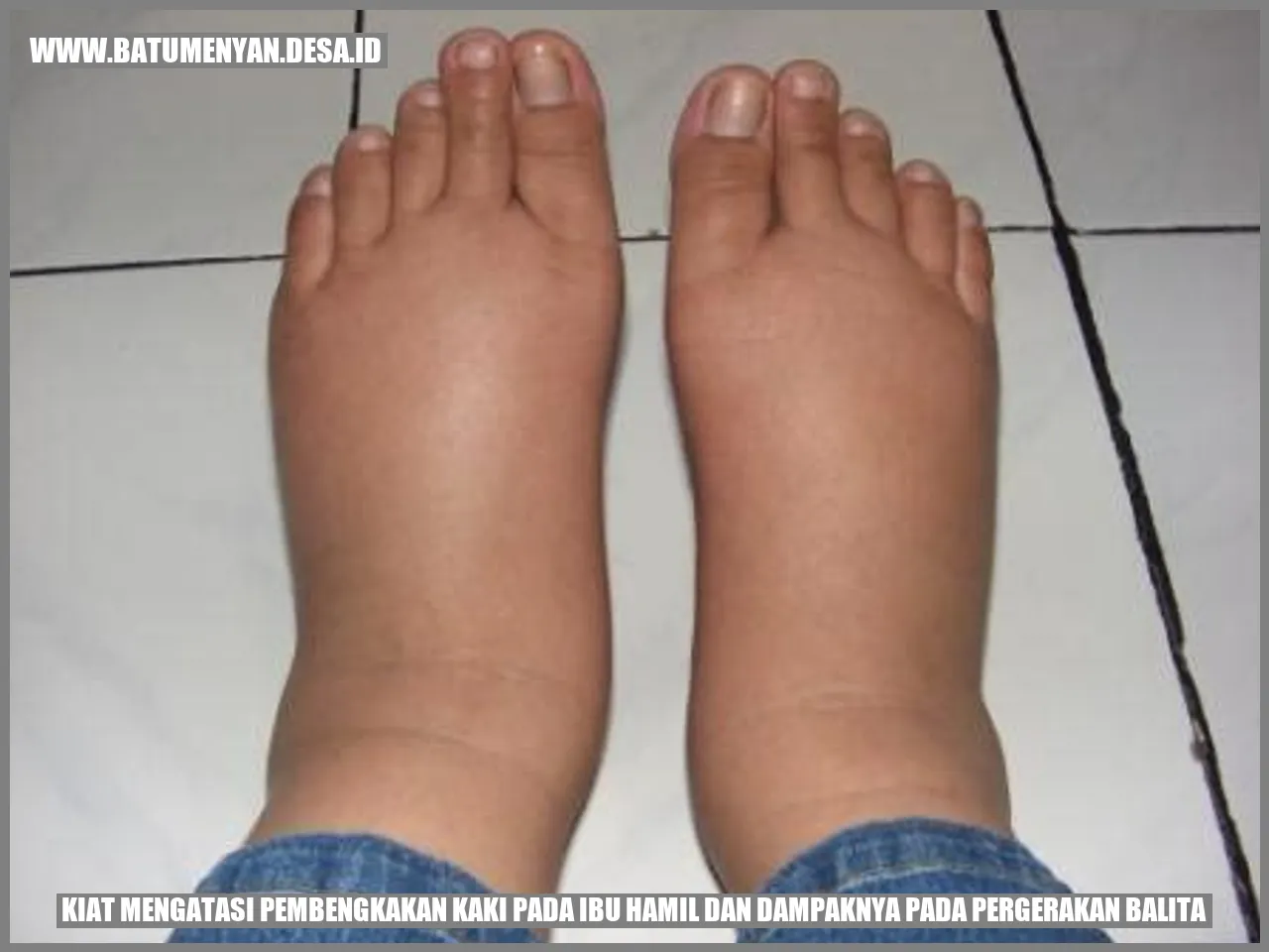 Kiat Mengatasi Pembengkakan Kaki pada Ibu Hamil dan Dampaknya pada Pergerakan Balita